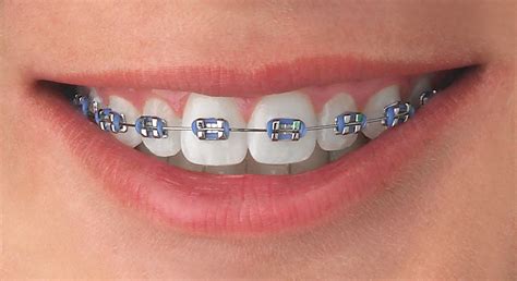 ligas de brackets azul metalico|moda de brackets de colores.